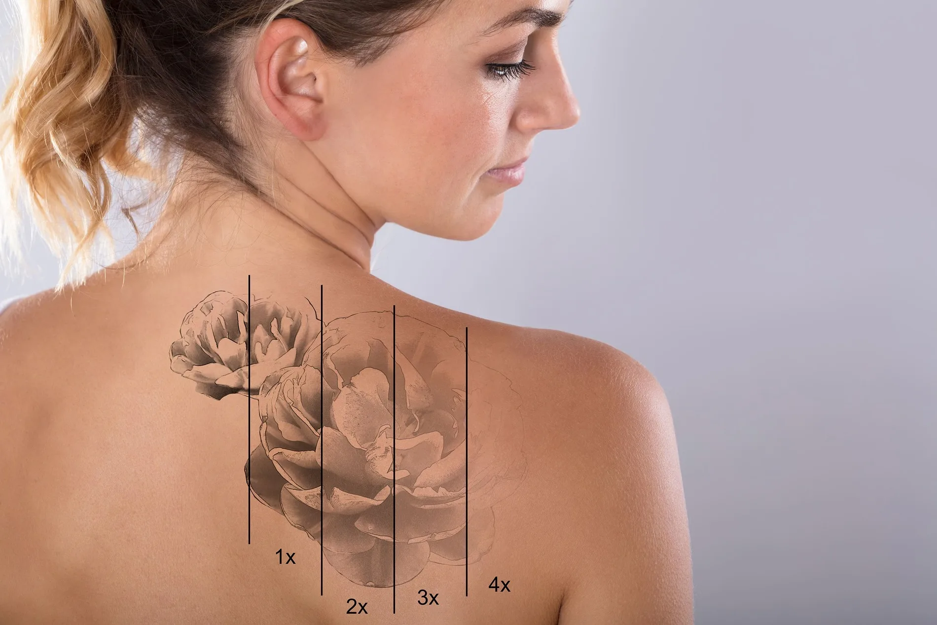 Remoção de tatuagem e micropigmentação a laser na Clínica Dermique