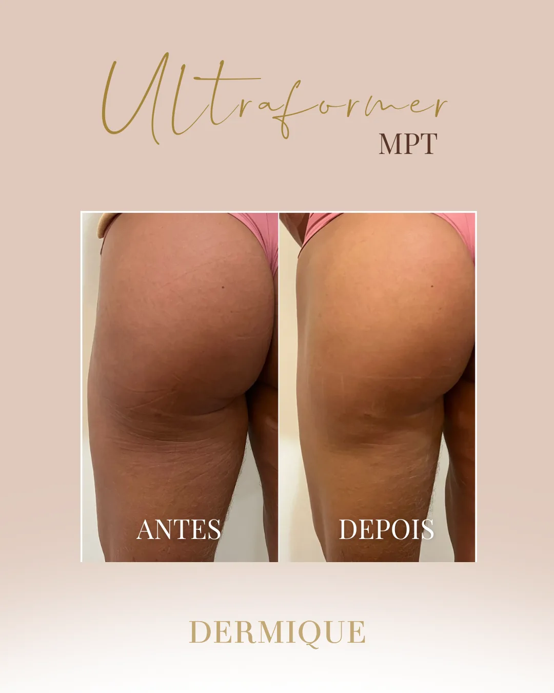 Ultraformer MPT — contorno facial na Clínica Dermique