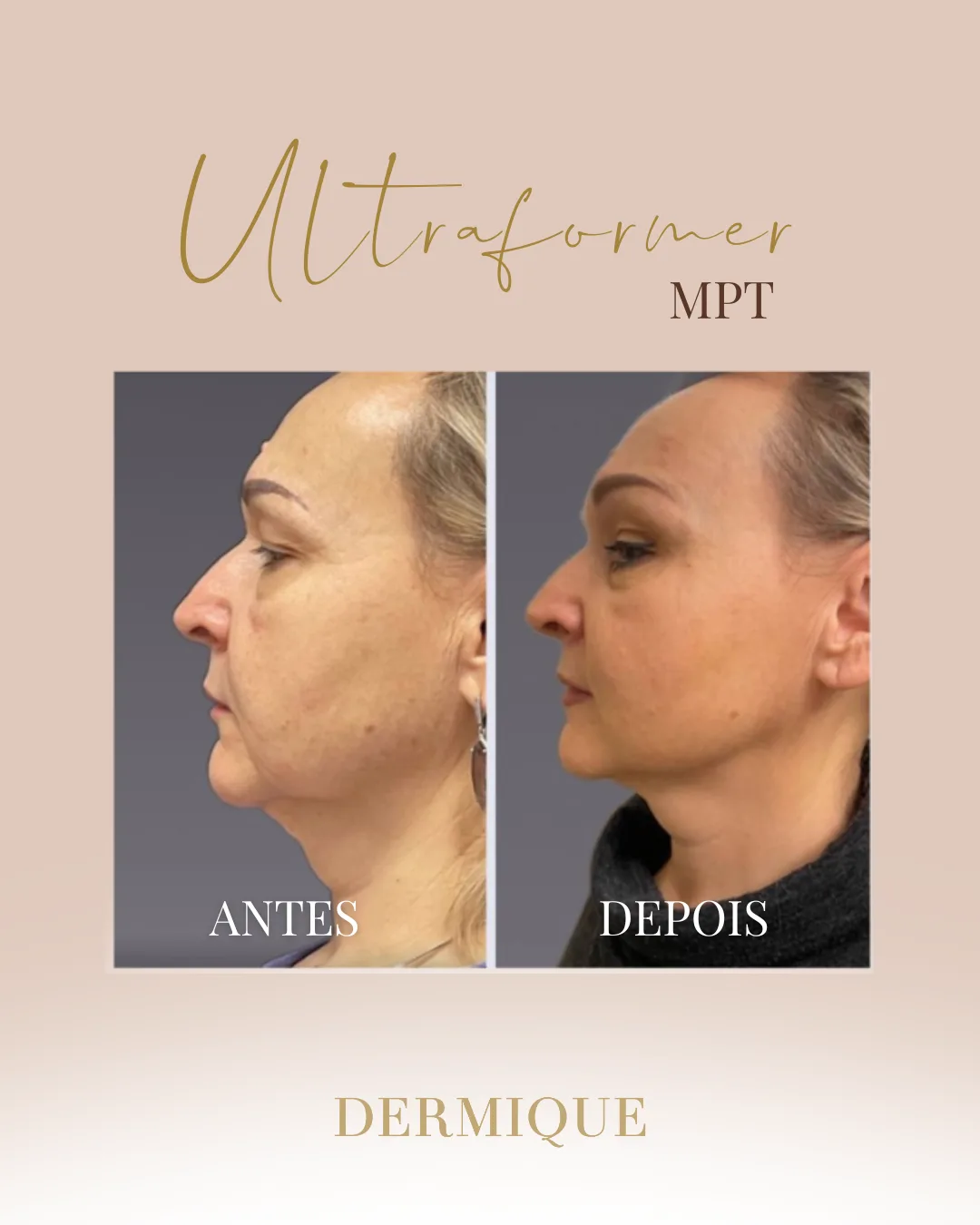 Ultraformer MPT — resultado na Clínica Dermique