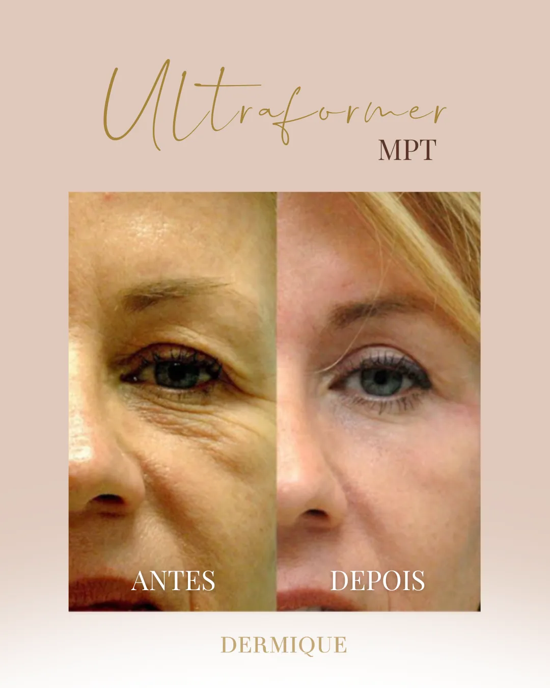 Ultraformer MPT — resultado na Clínica Dermique