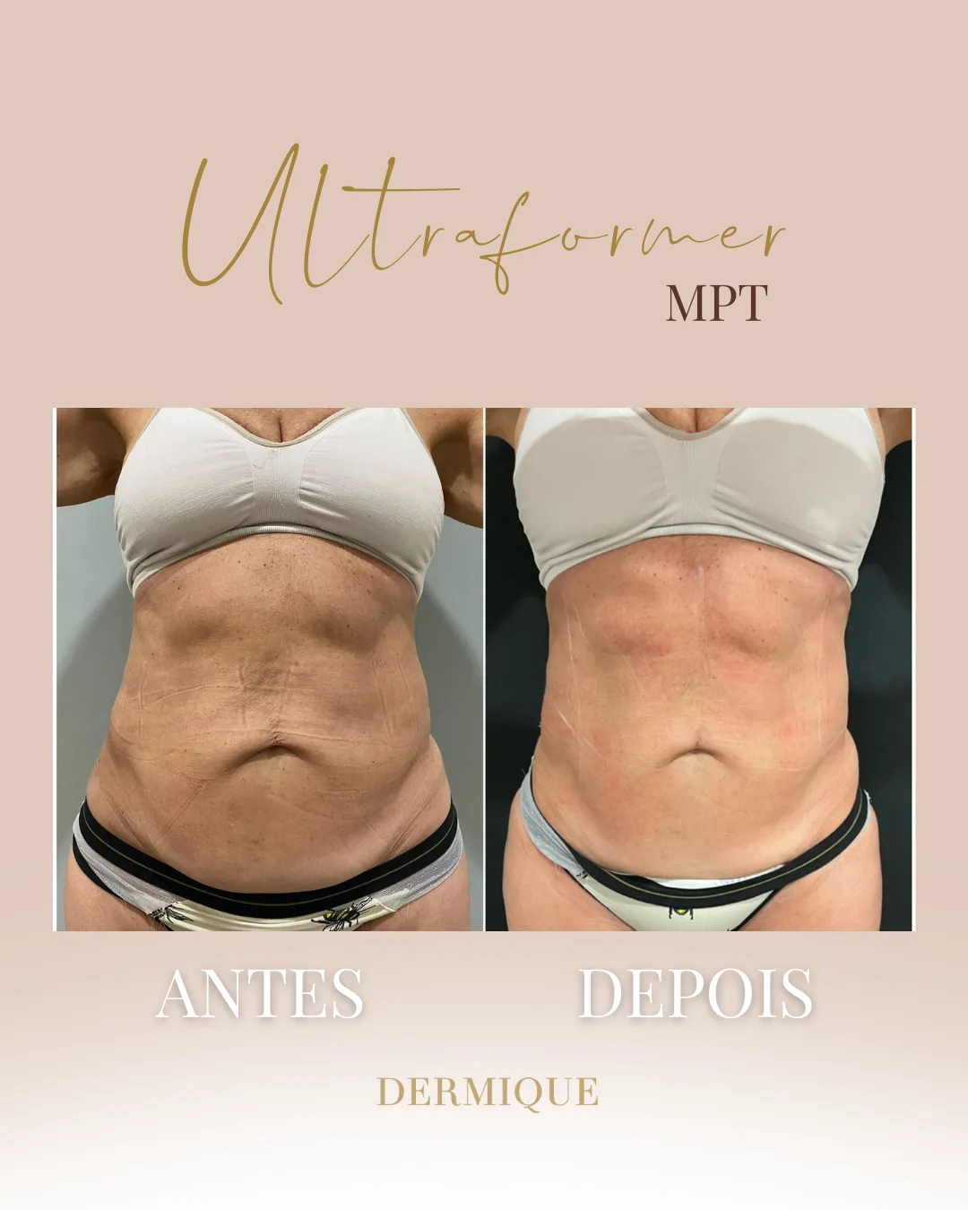 Ultraformer MPT — resultado na Clínica Dermique