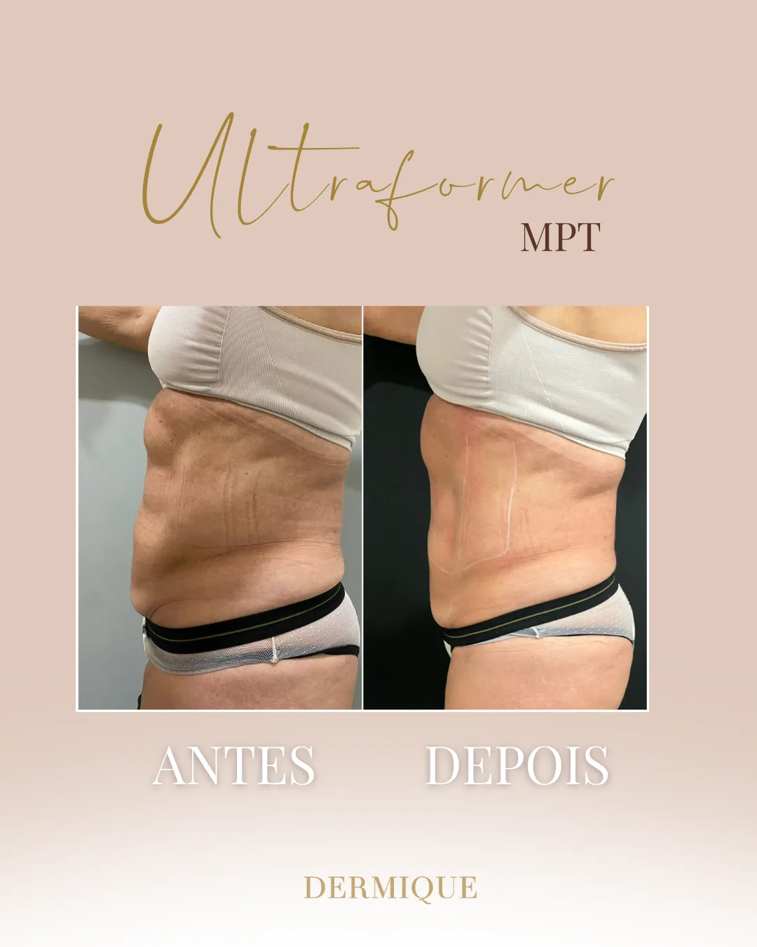 Ultraformer MPT — resultado de firmeza na Clínica Dermique
