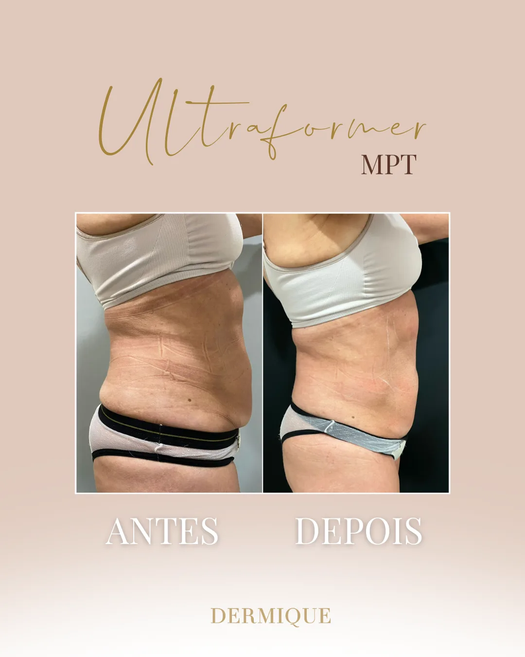 Ultraformer MPT — textura da pele na Clínica Dermique