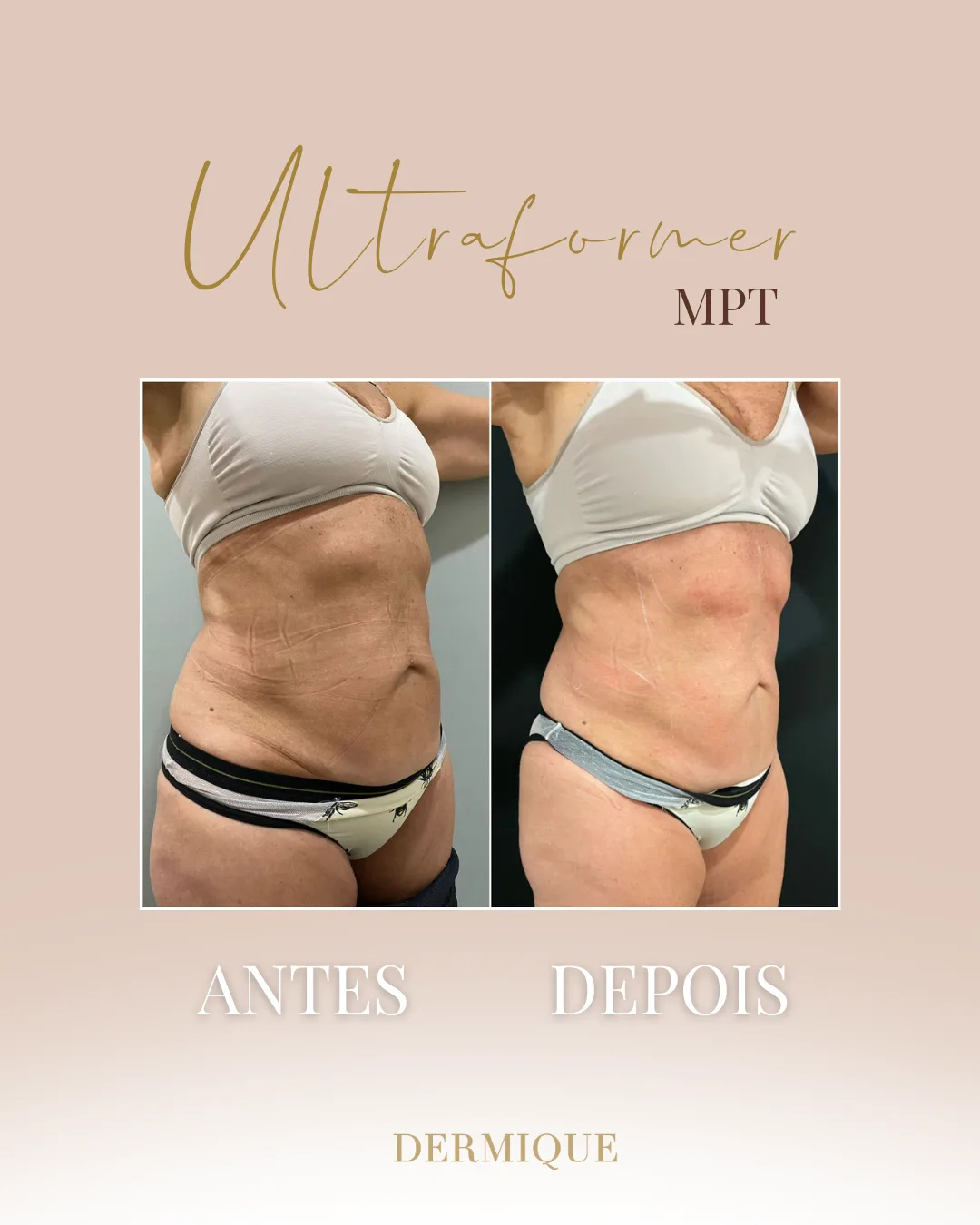 Ultraformer MPT — efeito lifting na Clínica Dermique