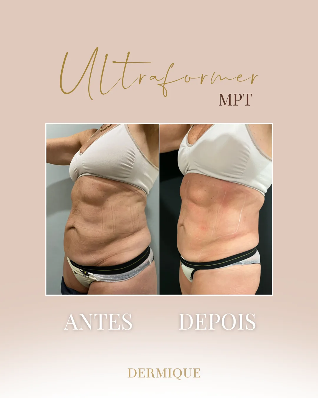 Ultraformer MPT — qualidade da pele na Clínica Dermique