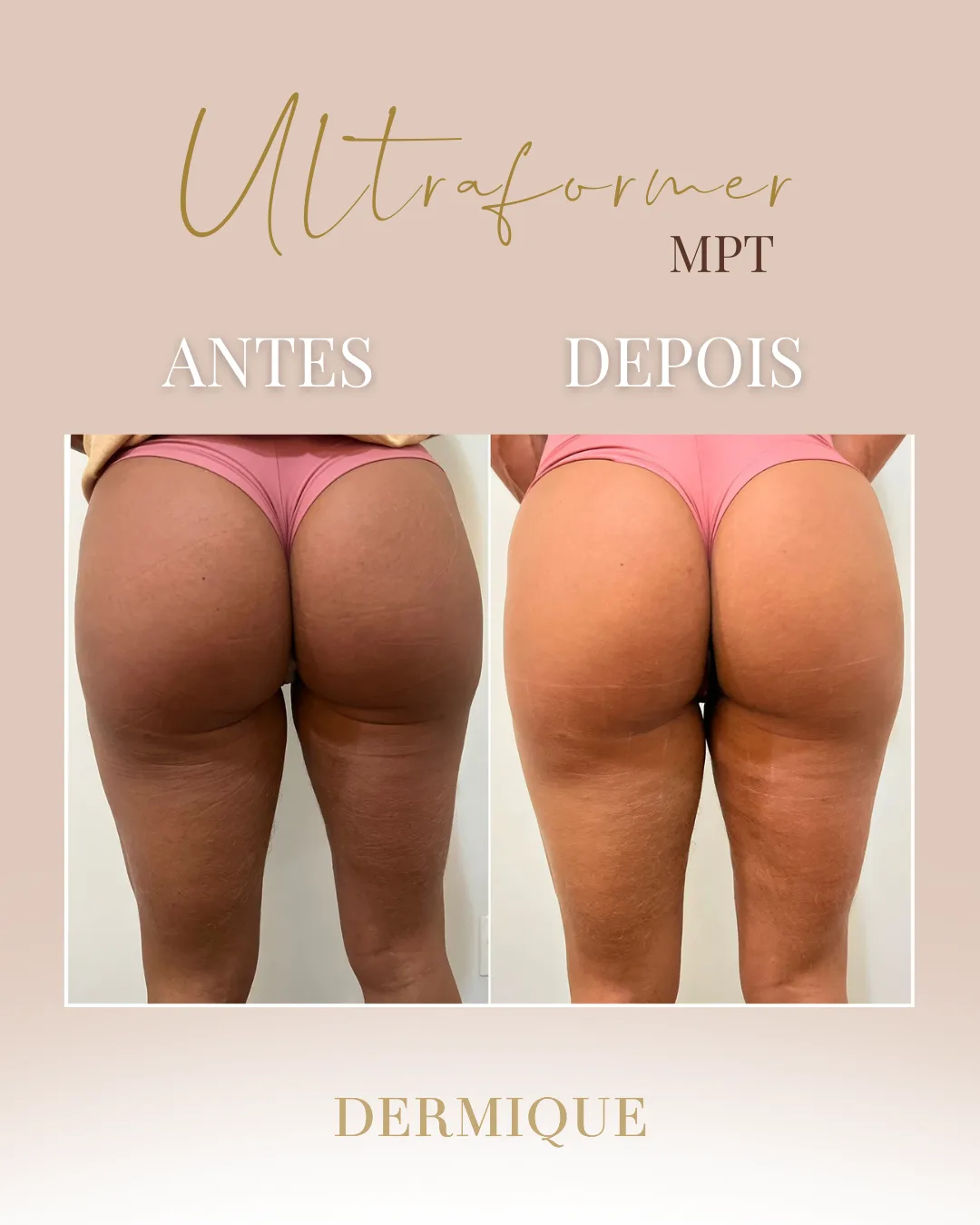Ultraformer MPT — antes e depois na Clínica Dermique