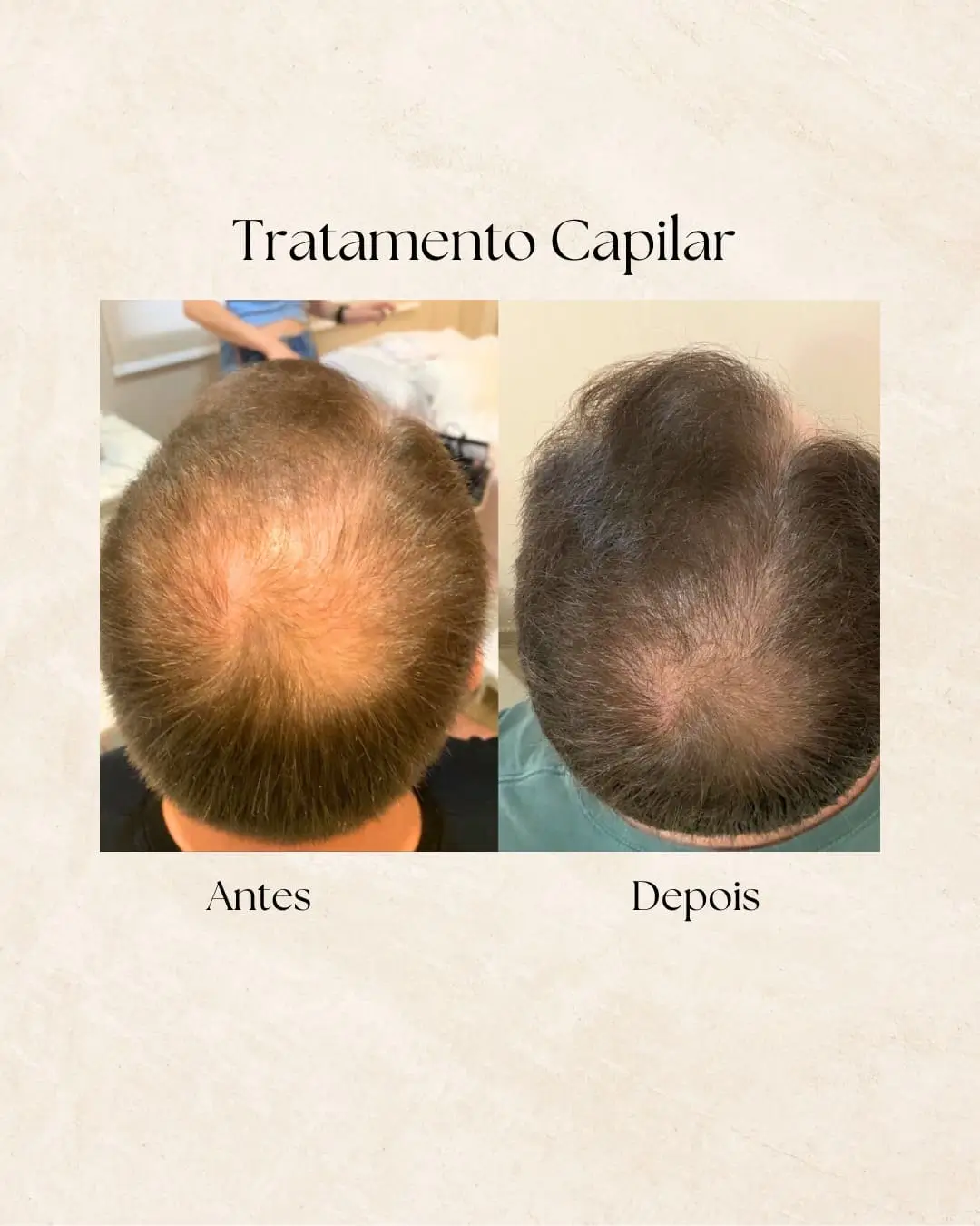 Tratamento capilar — densidade capilar