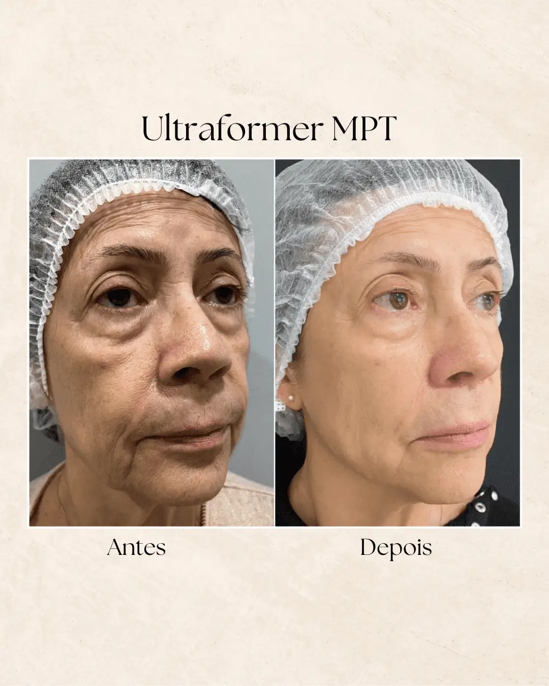 Ultraformer MPT — resultado na Clínica Dermique