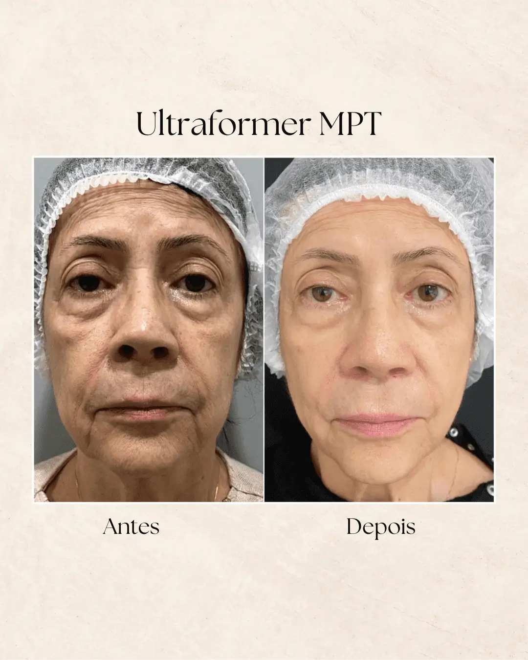 Ultraformer MPT — resultado na Clínica Dermique