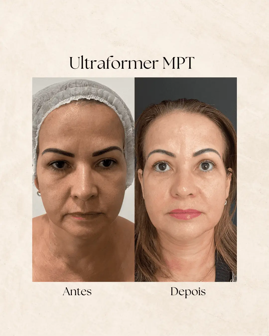 Ultraformer MPT — resultado na Clínica Dermique