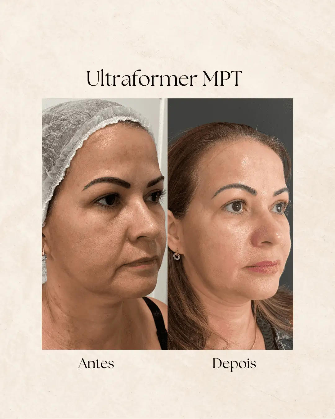 Ultraformer MPT — resultado na Clínica Dermique