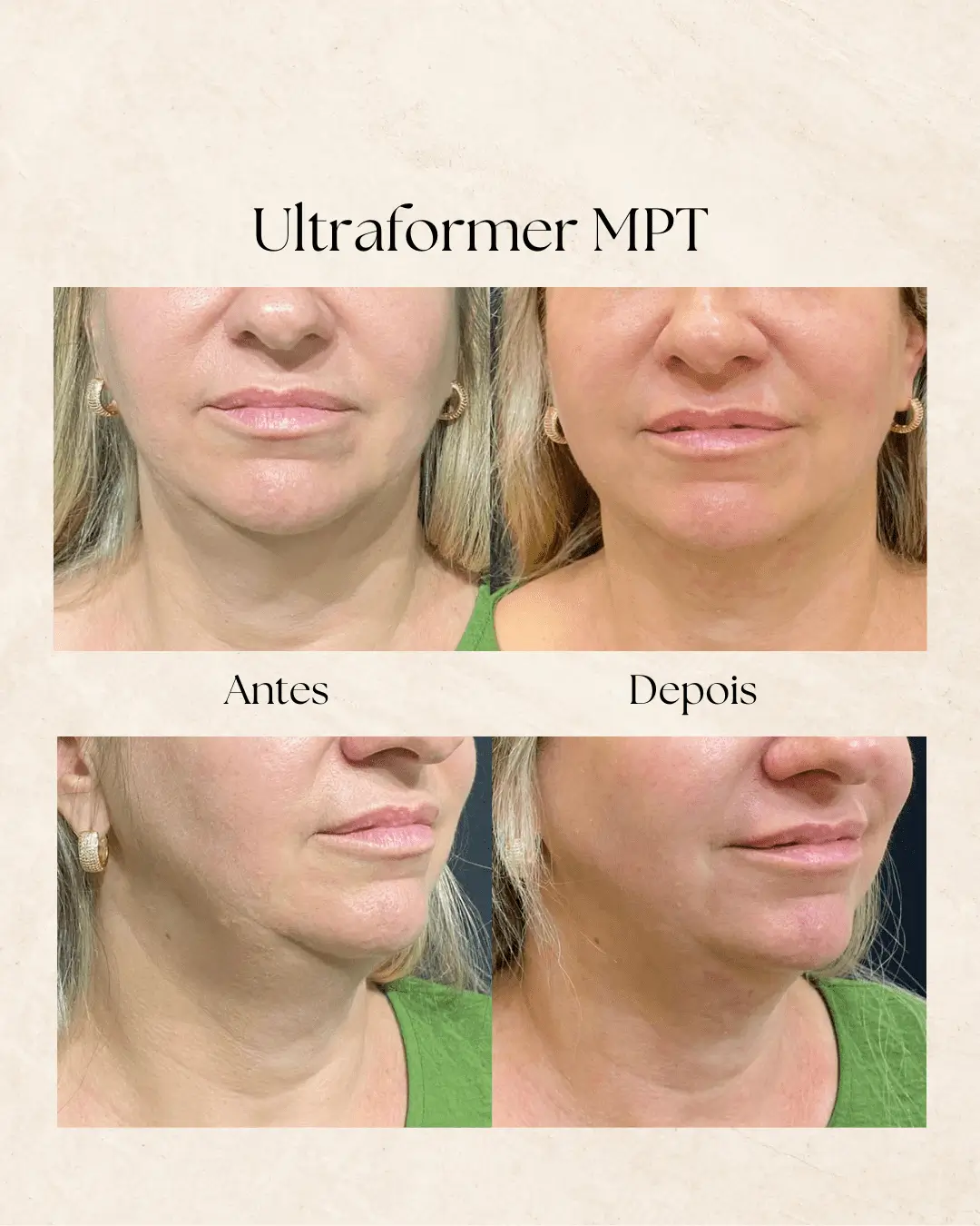 Ultraformer MPT — resultado na Clínica Dermique
