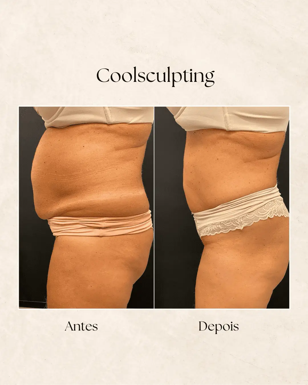 Resultado Coolsculpting