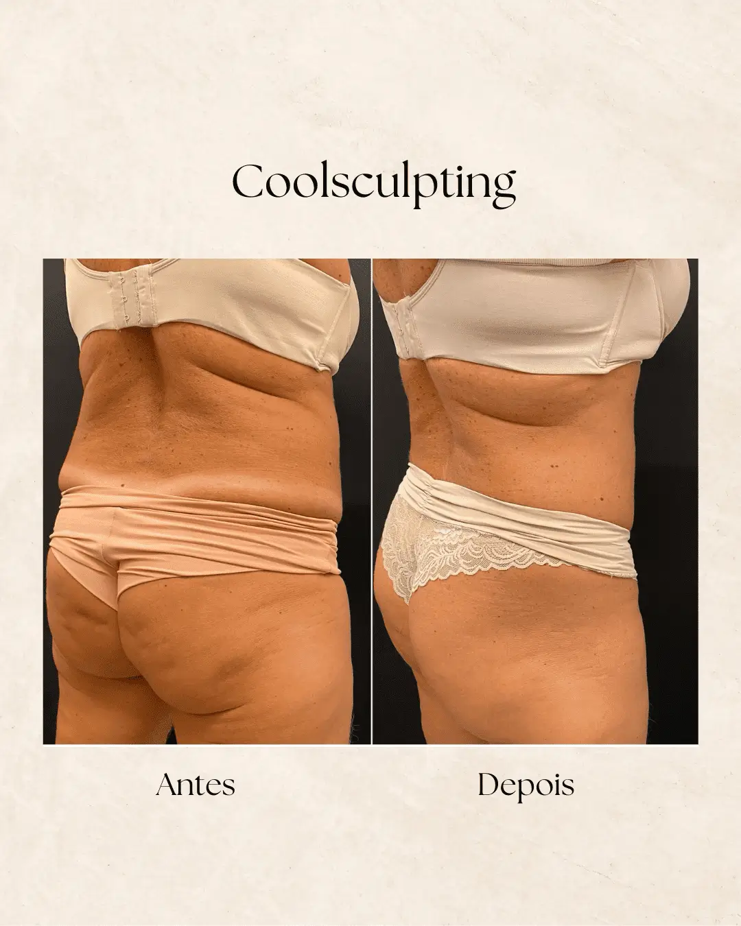 Coolsculpting — redução de gordura localizada
