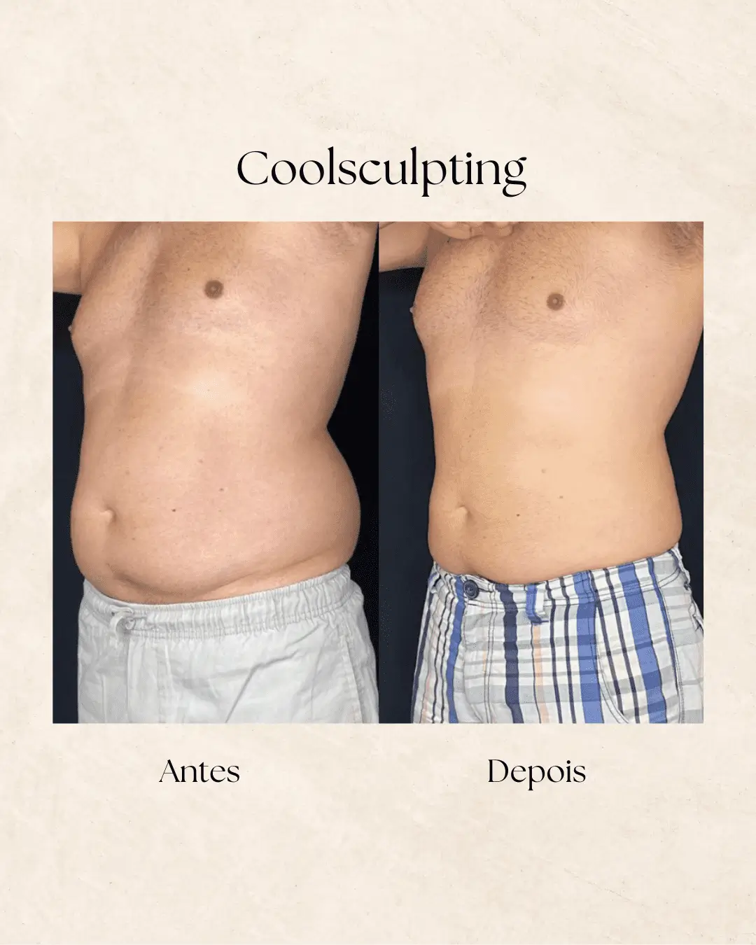 Coolsculpting — contorno corporal
