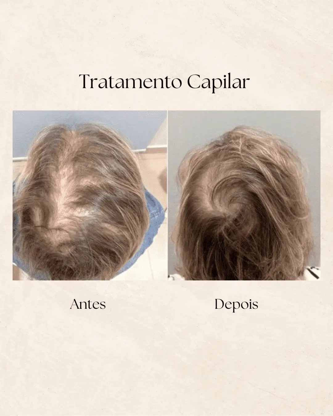 Tratamento capilar — crescimento de novos fios