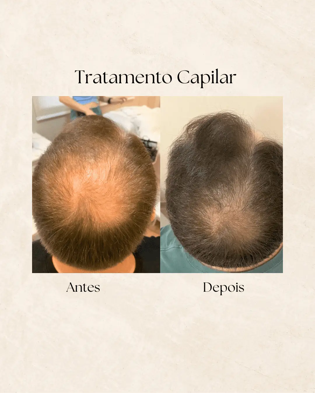 Tratamento capilar — recuperação folicular