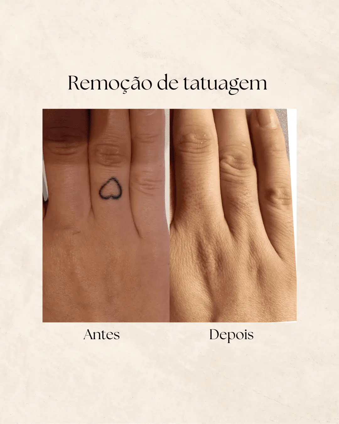 Resultado de remoção de tatuagem a laser na Clínica Dermique