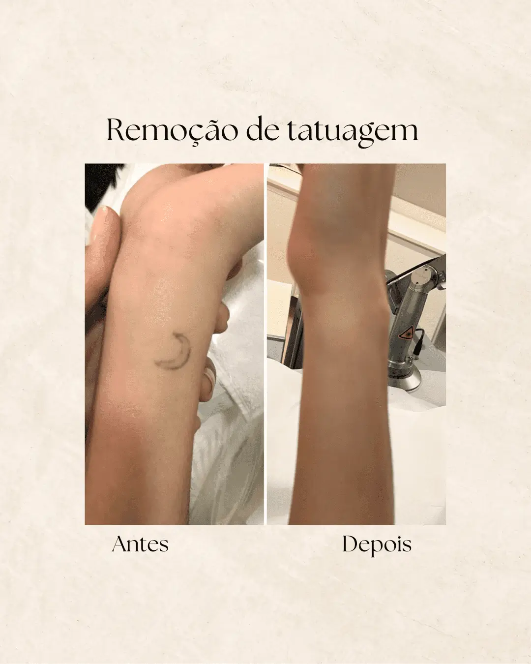 Remoção de tatuagem — resultado adicional