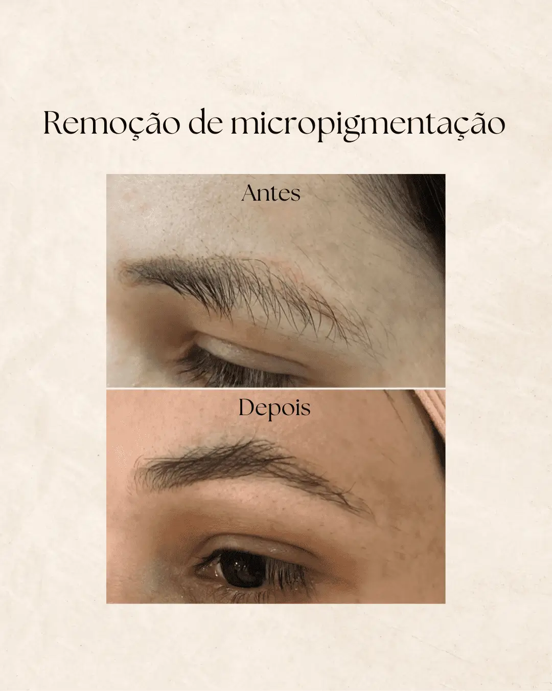 Remoção de micropigmentação — resultado 2