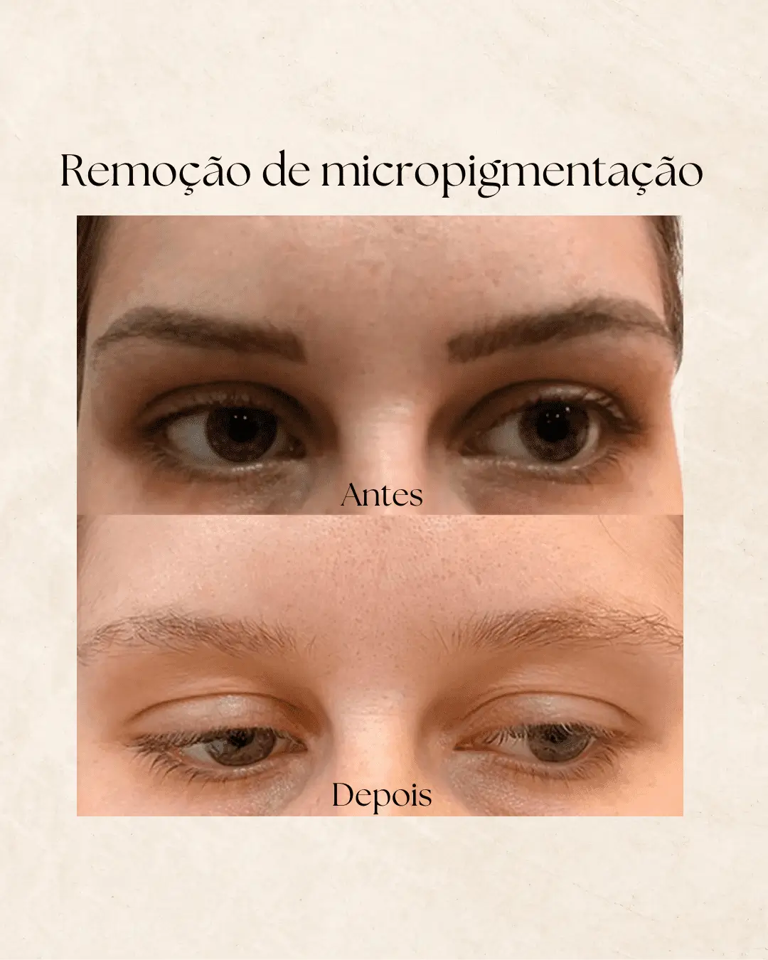 Remoção de micropigmentação — resultado 1