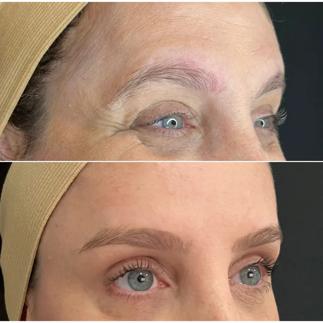 Resultado real do Botox Club da Dermique