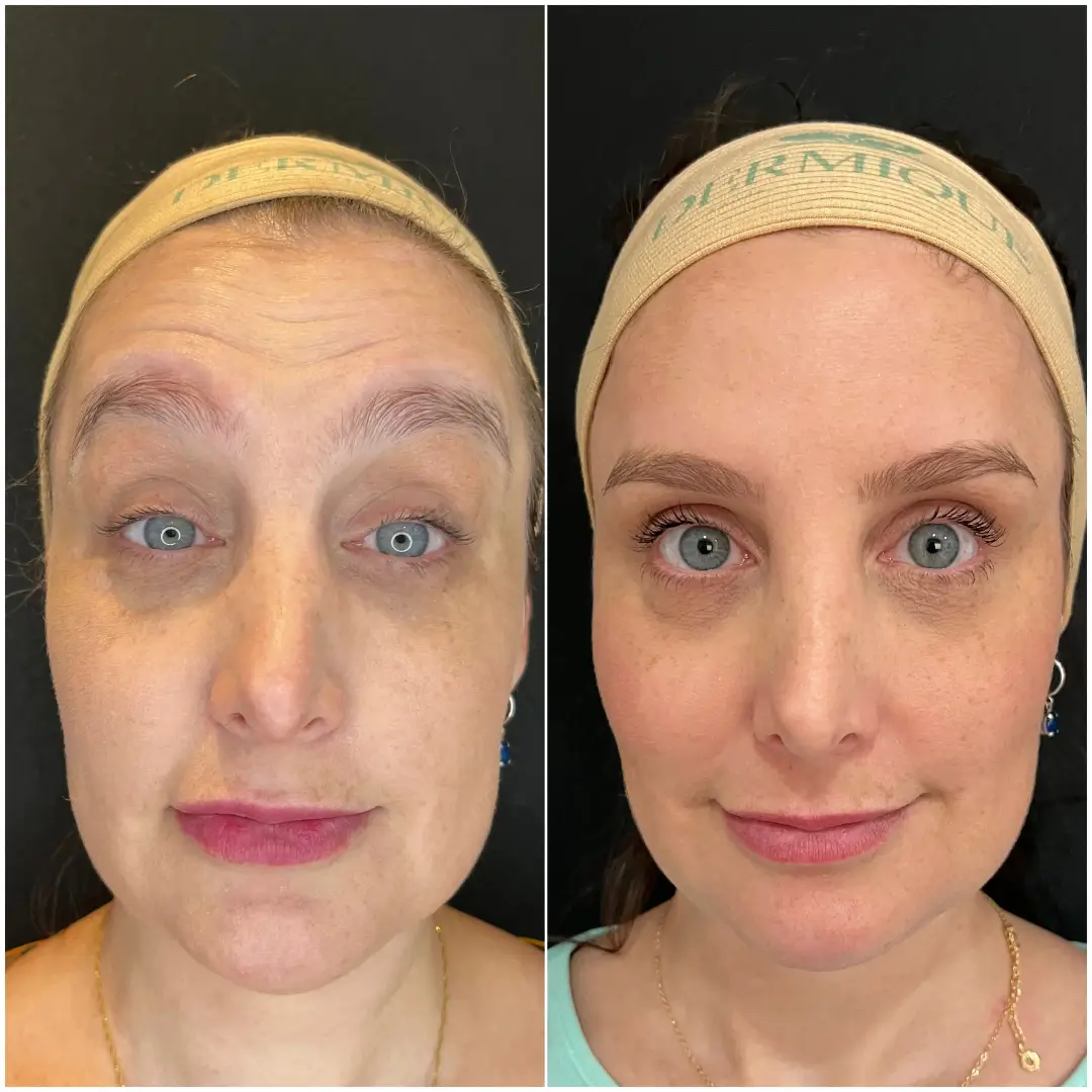 Resultado real do Botox Club da Dermique