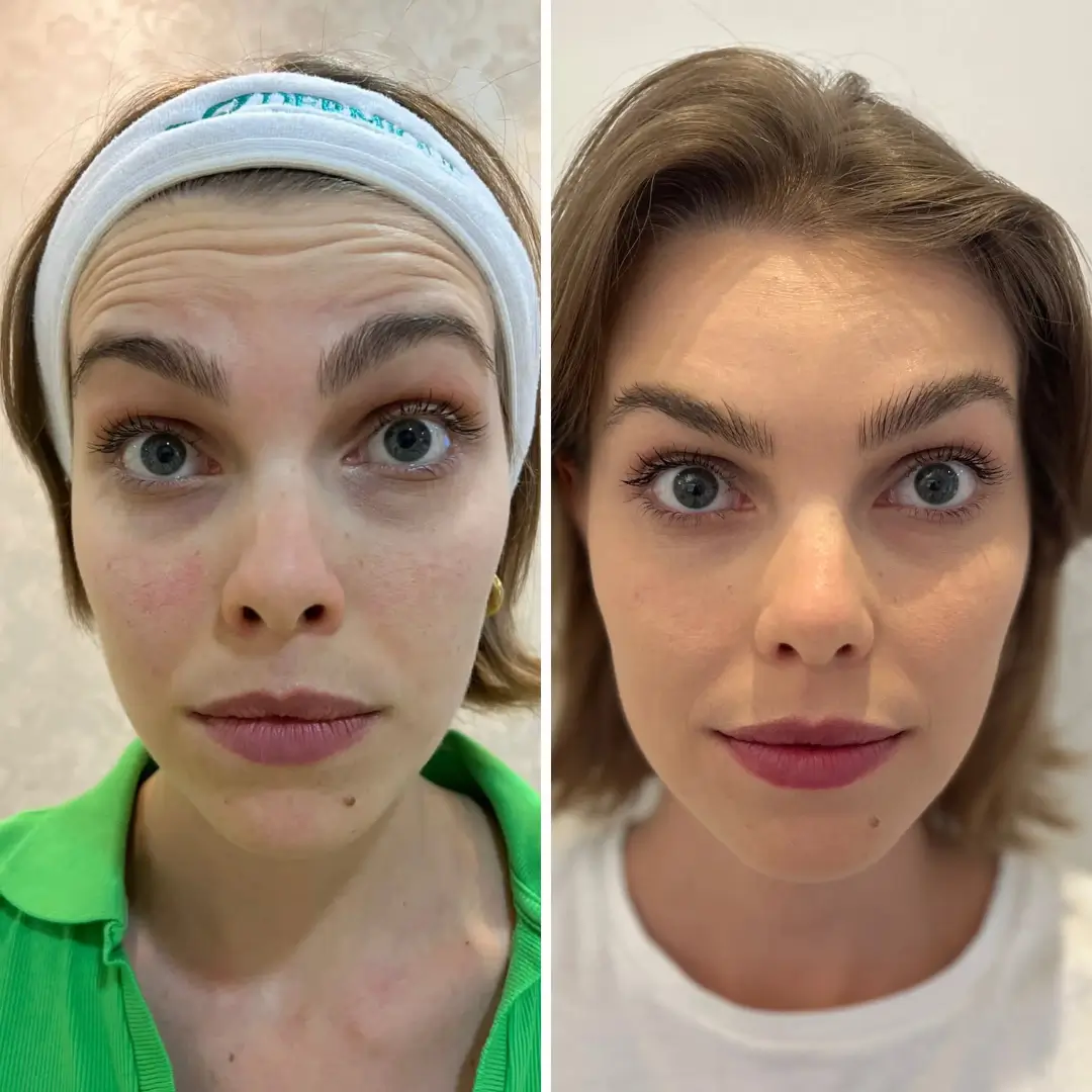 Resultado real do Botox Club da Dermique