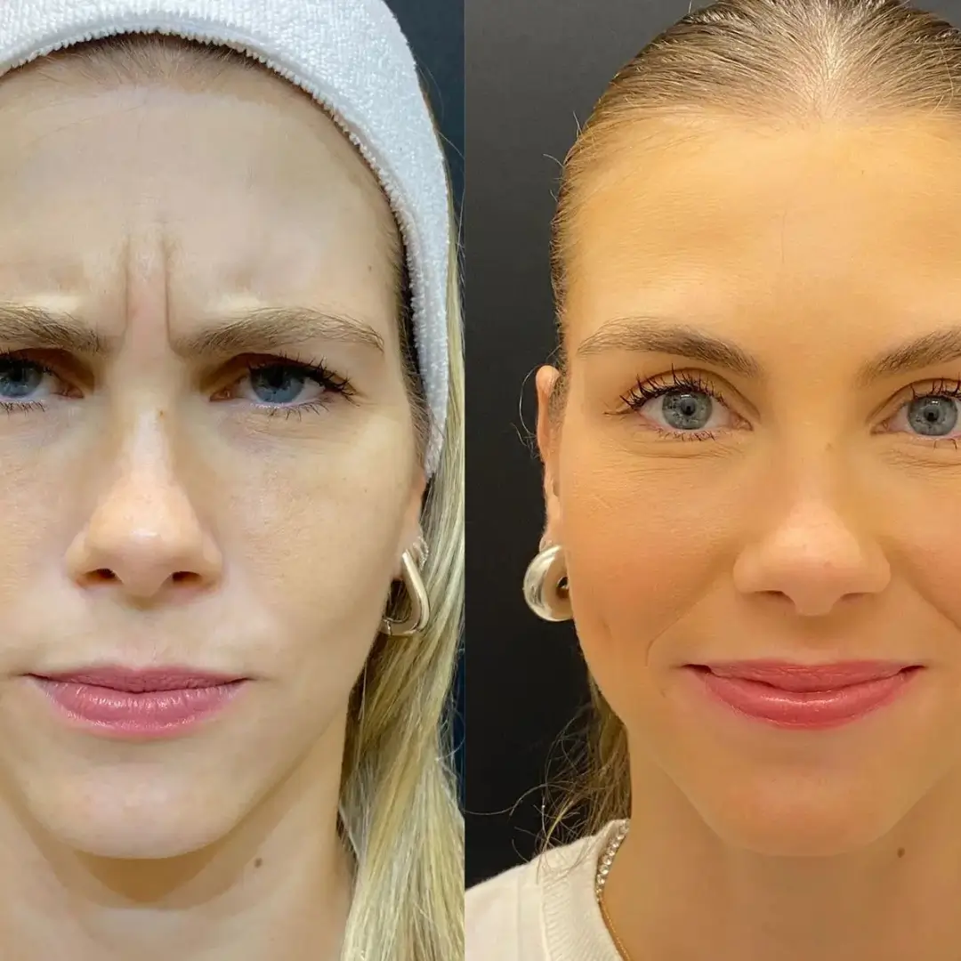 Resultado real do Botox Club da Dermique