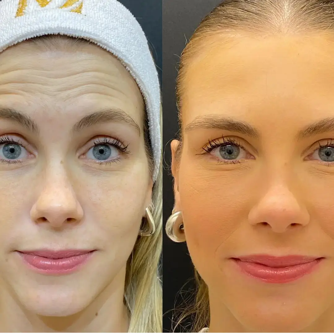Resultado real do Botox Club da Dermique