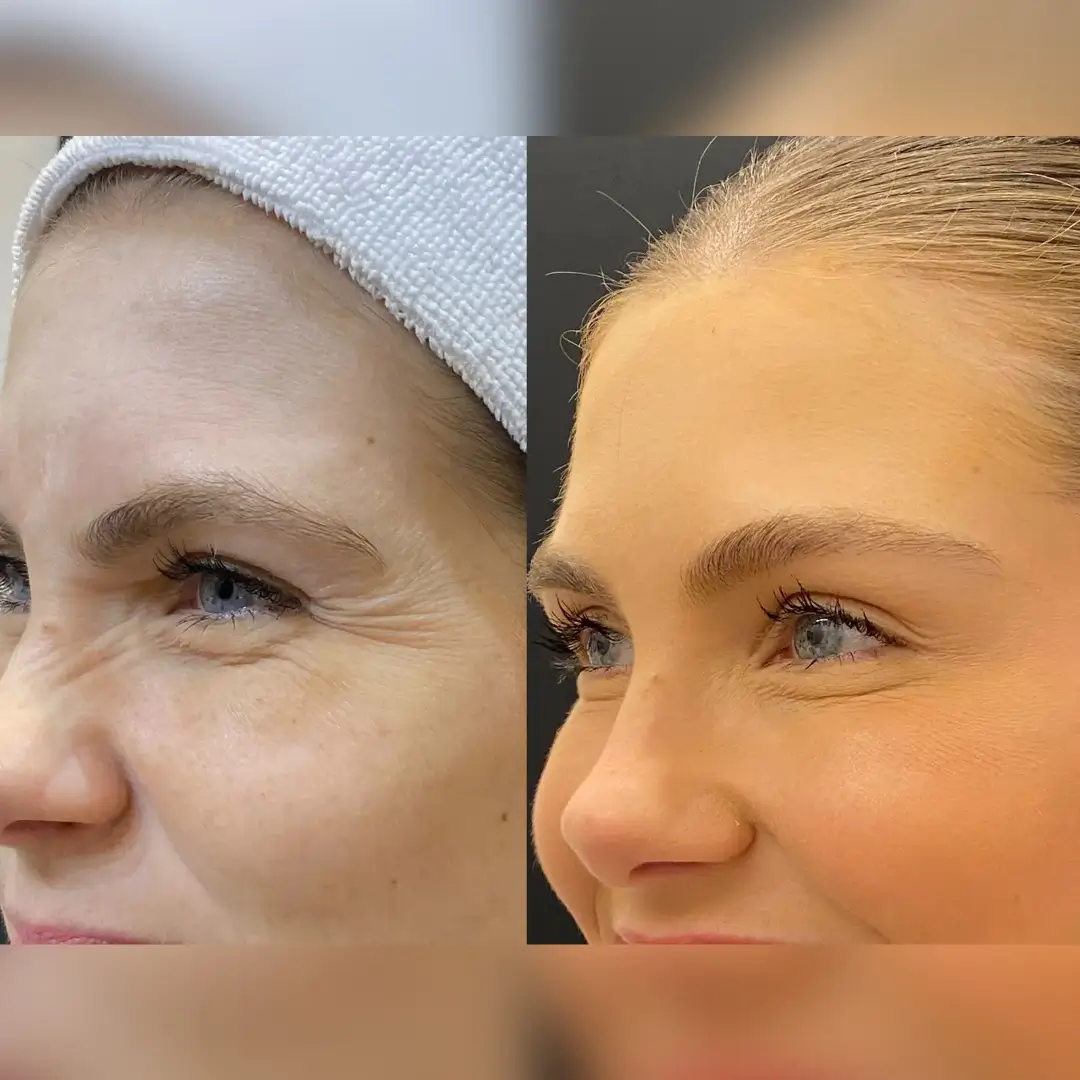 Resultado real do Botox Club da Dermique