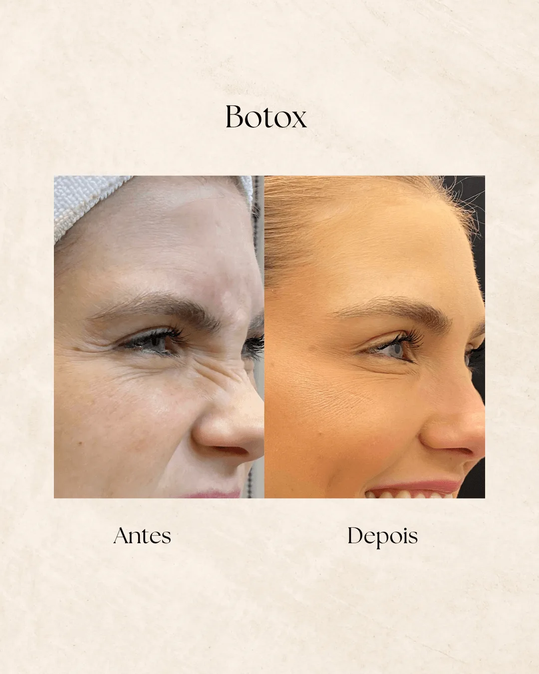 Botox antes e depois 1