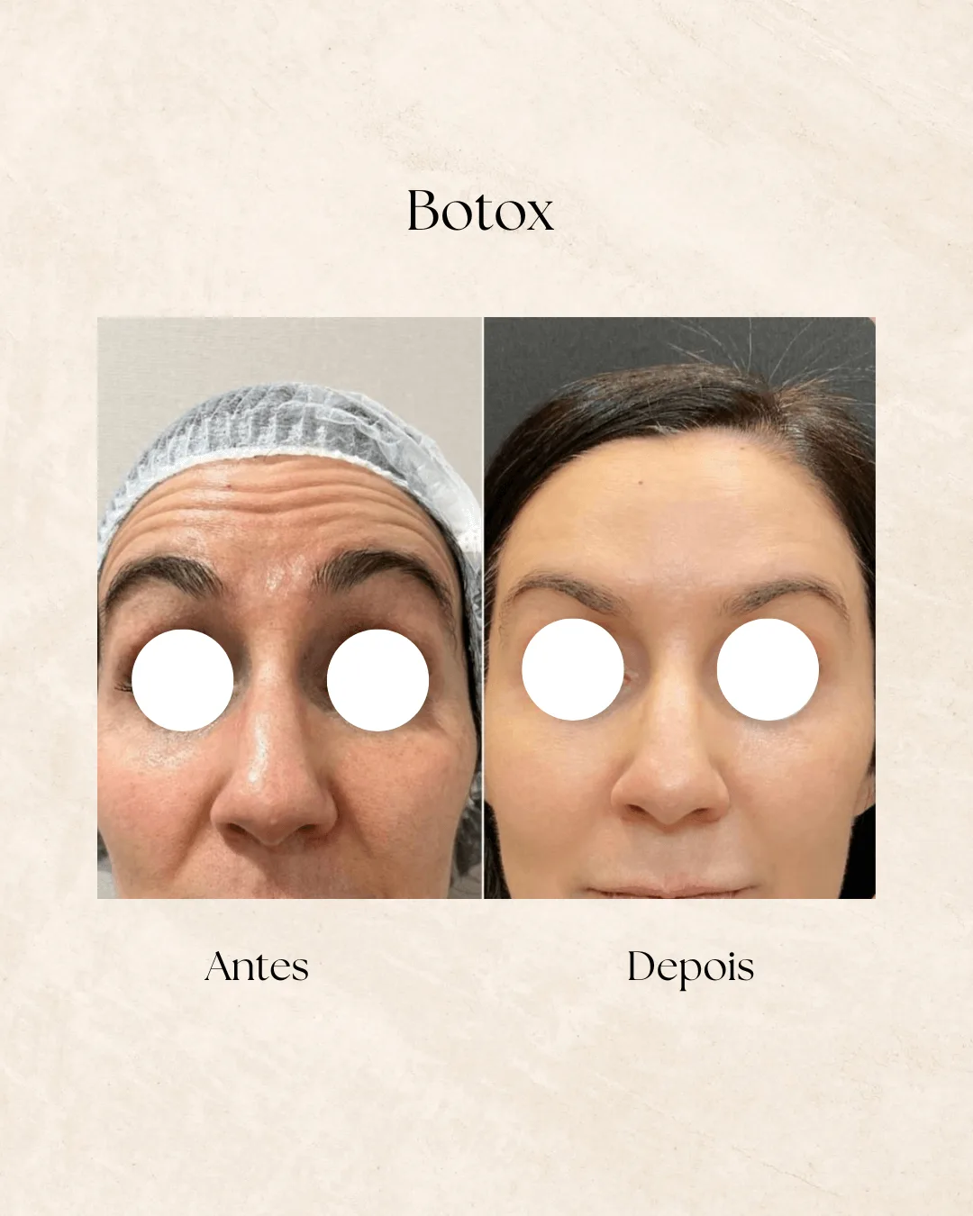 Botox antes e depois 2