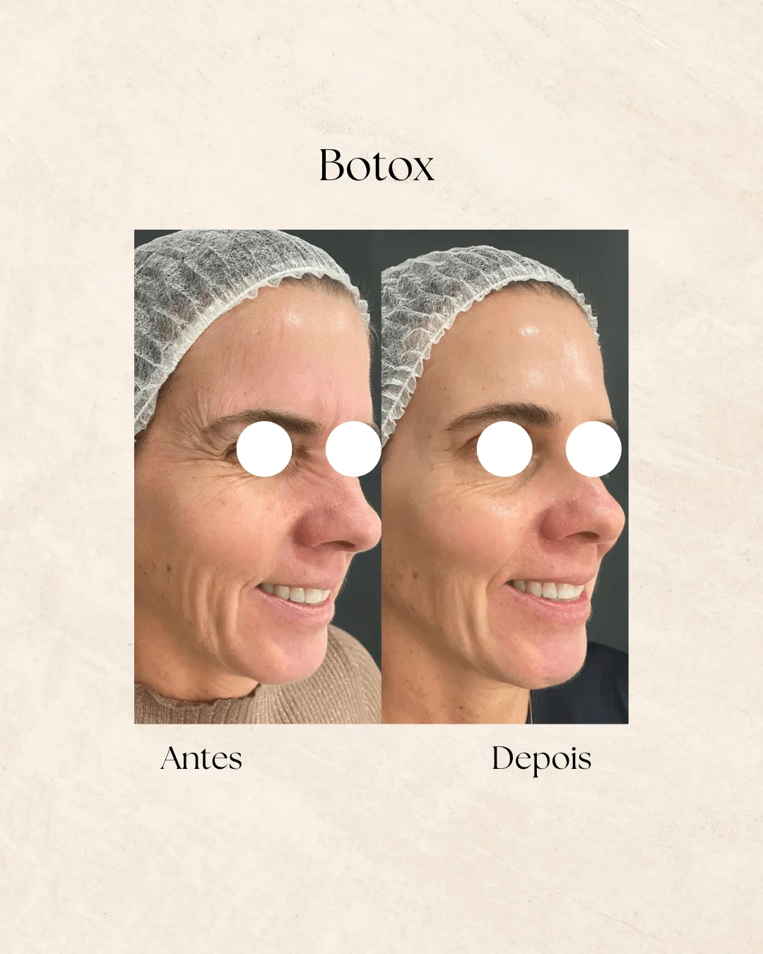 Botox antes e depois 3