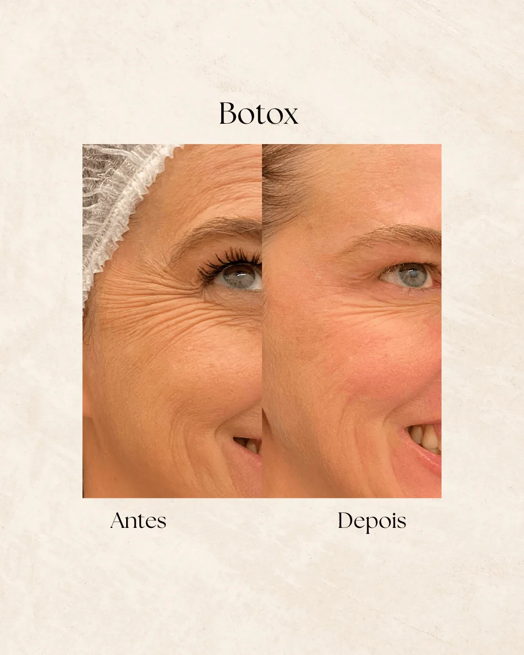 Botox antes e depois 4