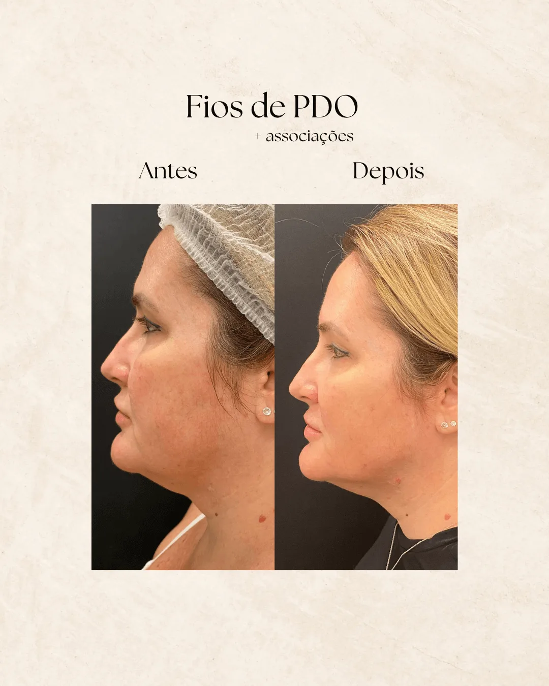 Fios de PDO antes e depois 1