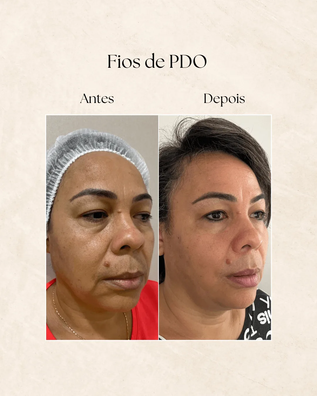 Fios de PDO antes e depois 2