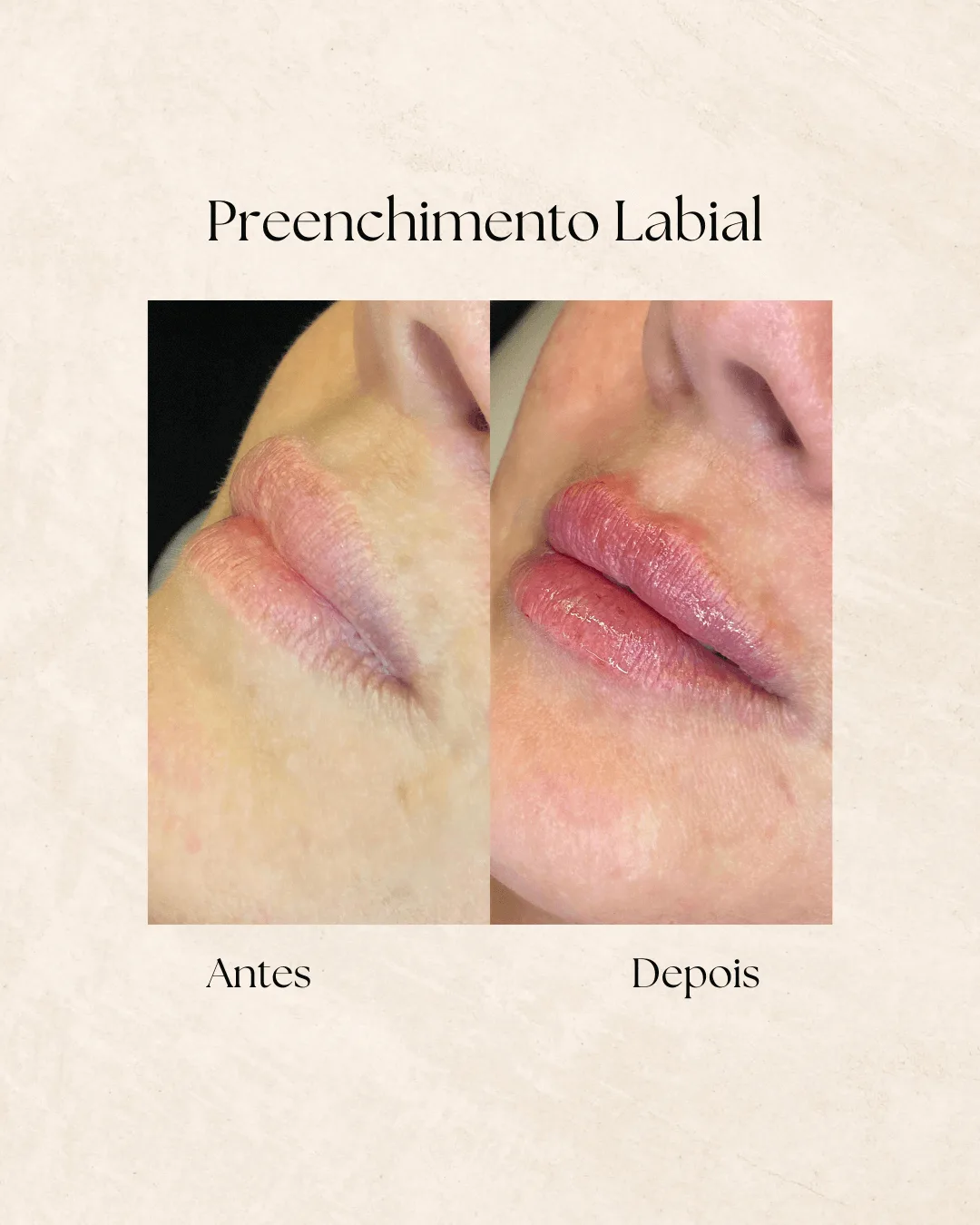 Harmonização facial antes e depois 1