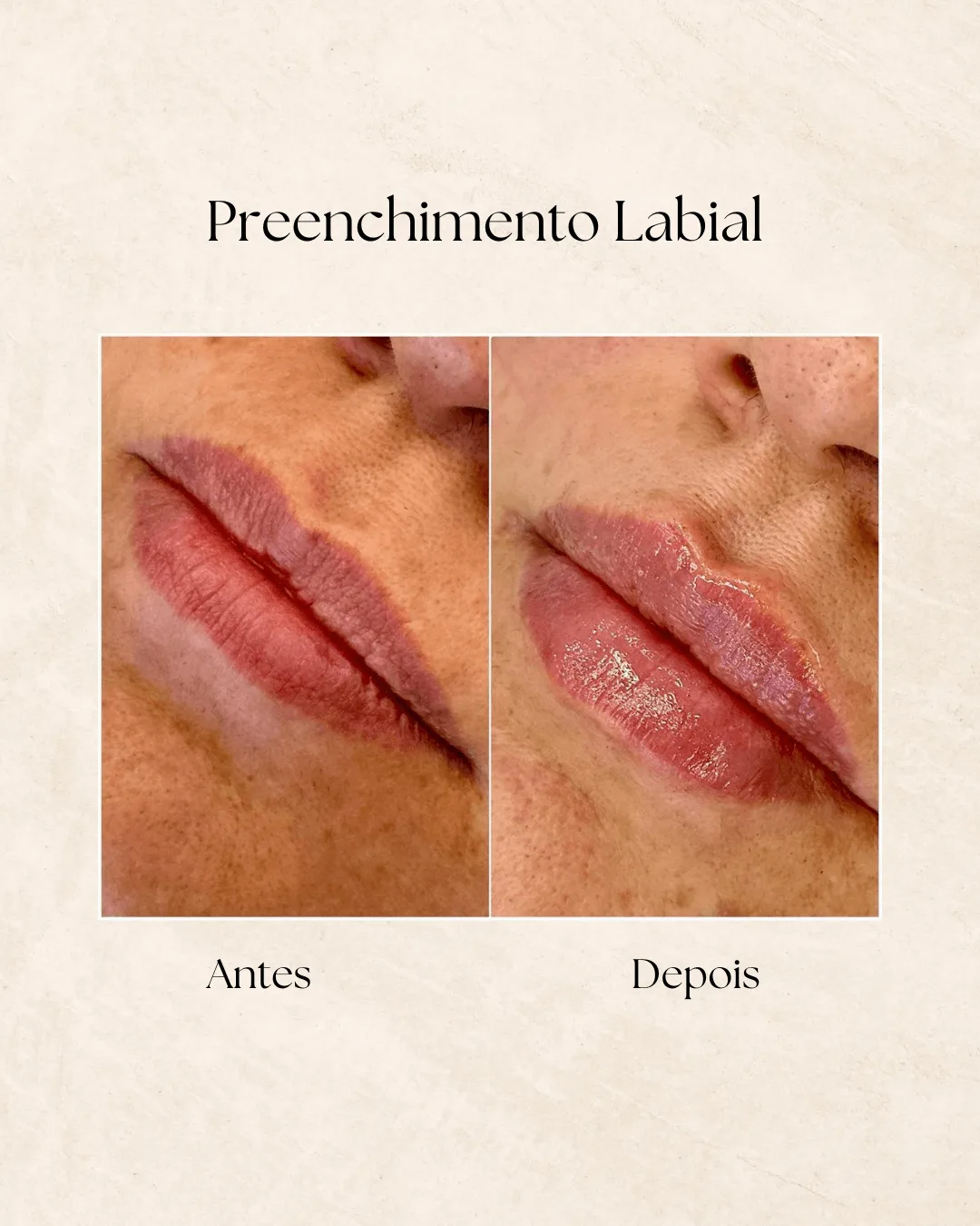 Harmonização facial antes e depois 2