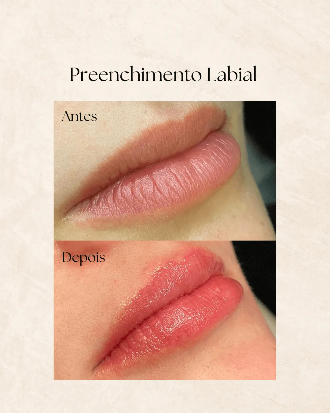 Harmonização facial antes e depois 3