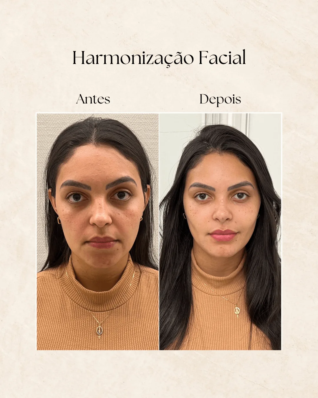 Antes e depois de harmonização facial