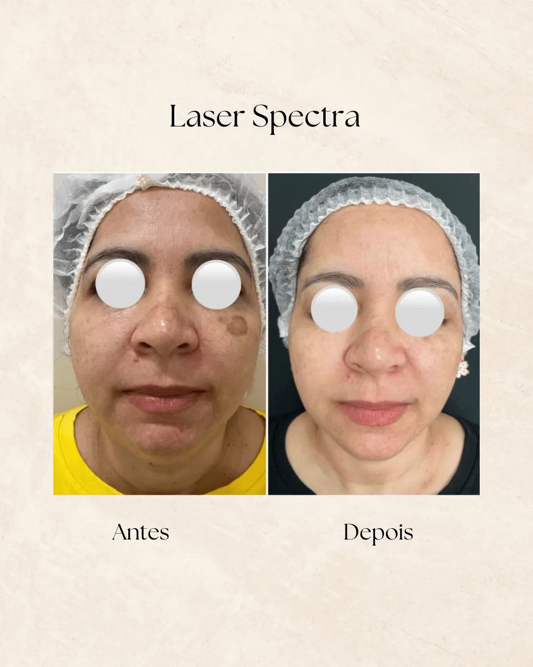Spectra Laser Toning antes e depois