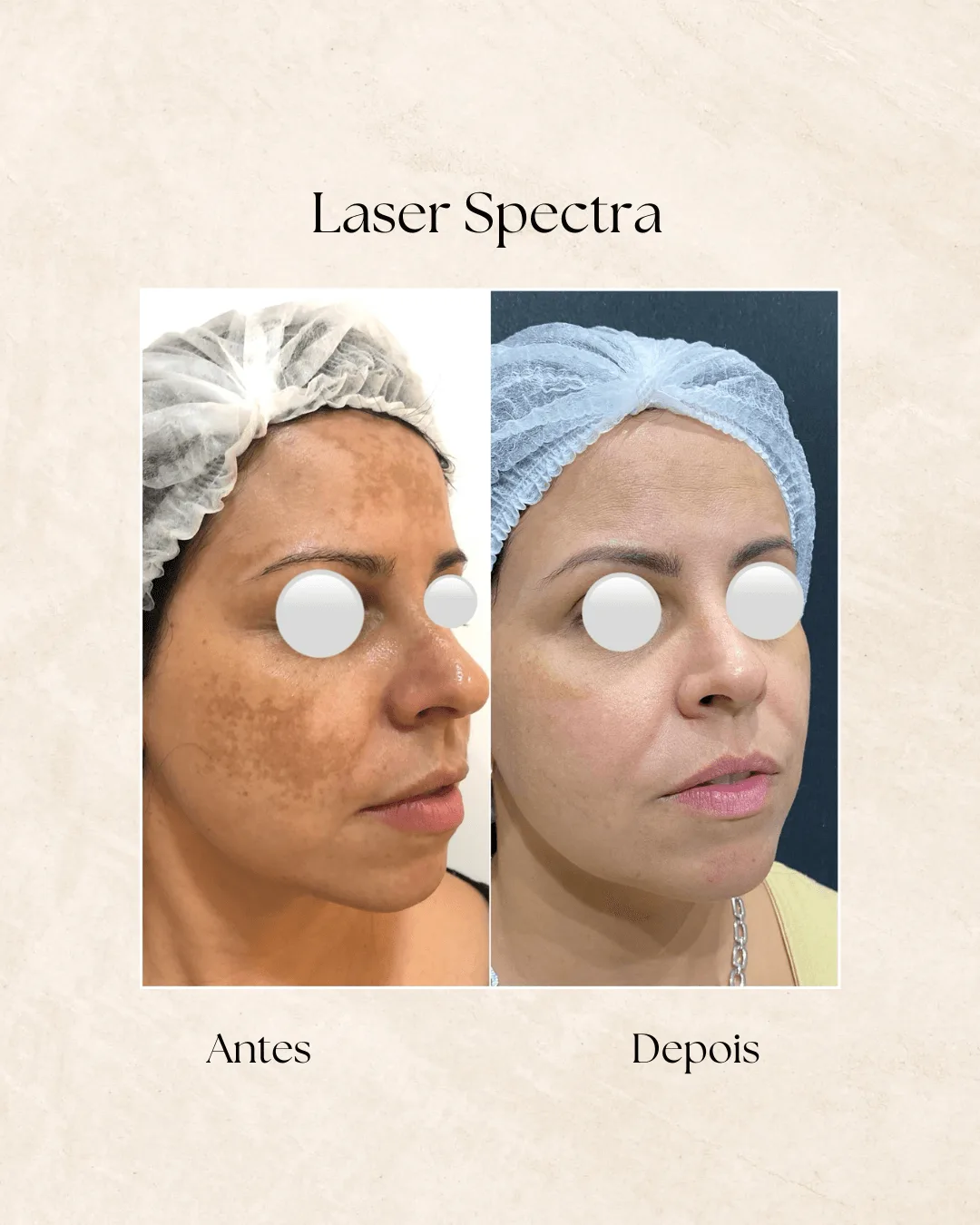 Spectra Laser Toning antes e depois