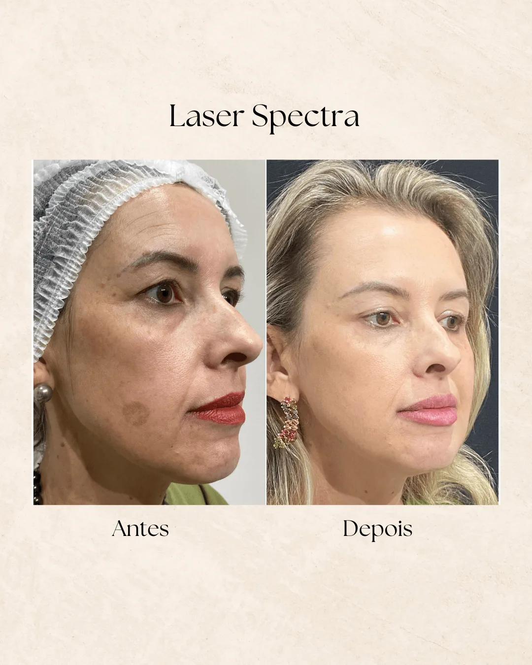 Antes e depois de tratamento com laser Spectra