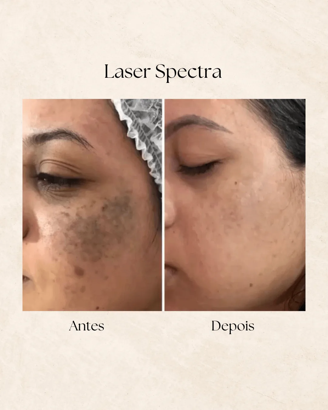 Spectra Laser Toning antes e depois