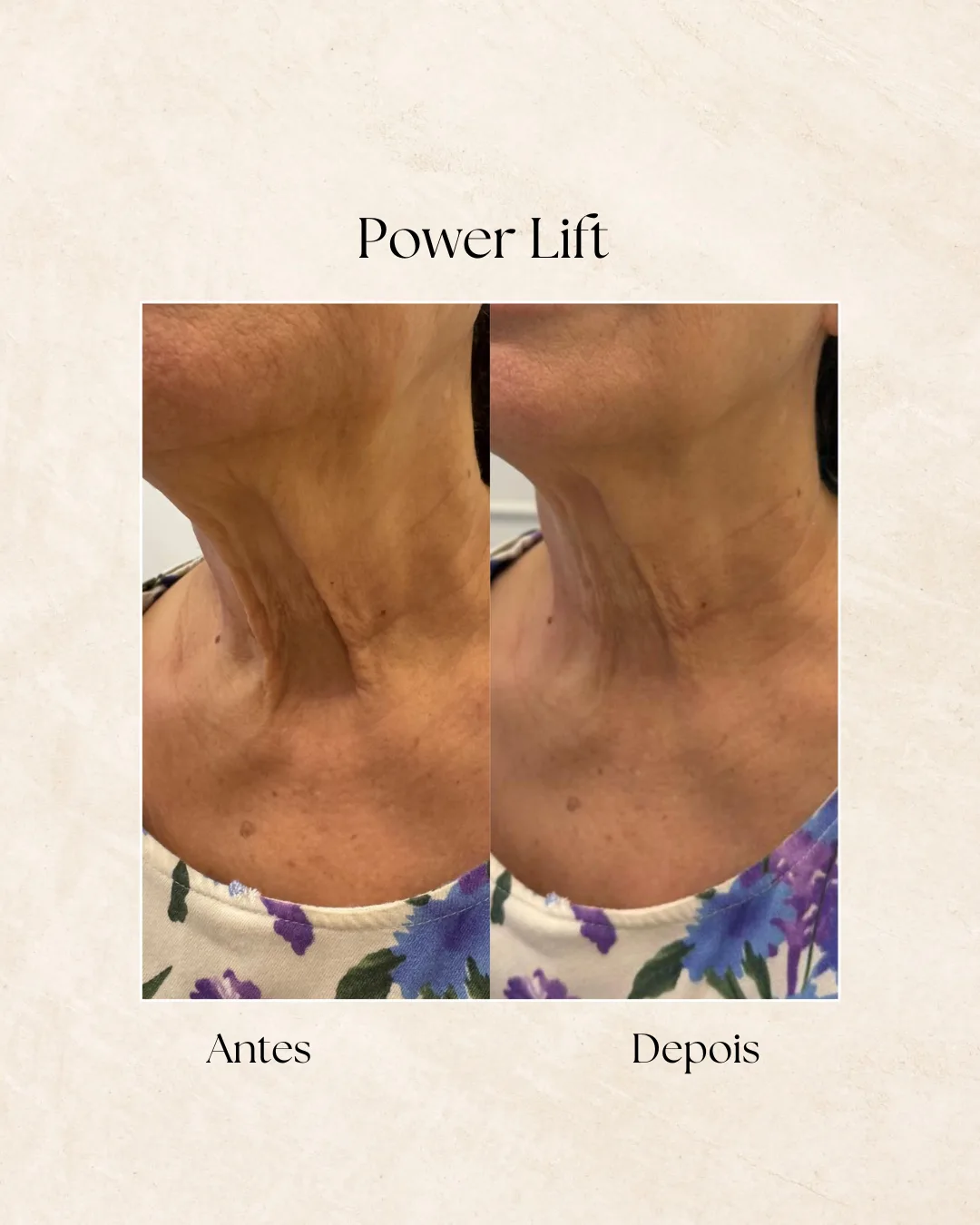 Power Lift antes e depois