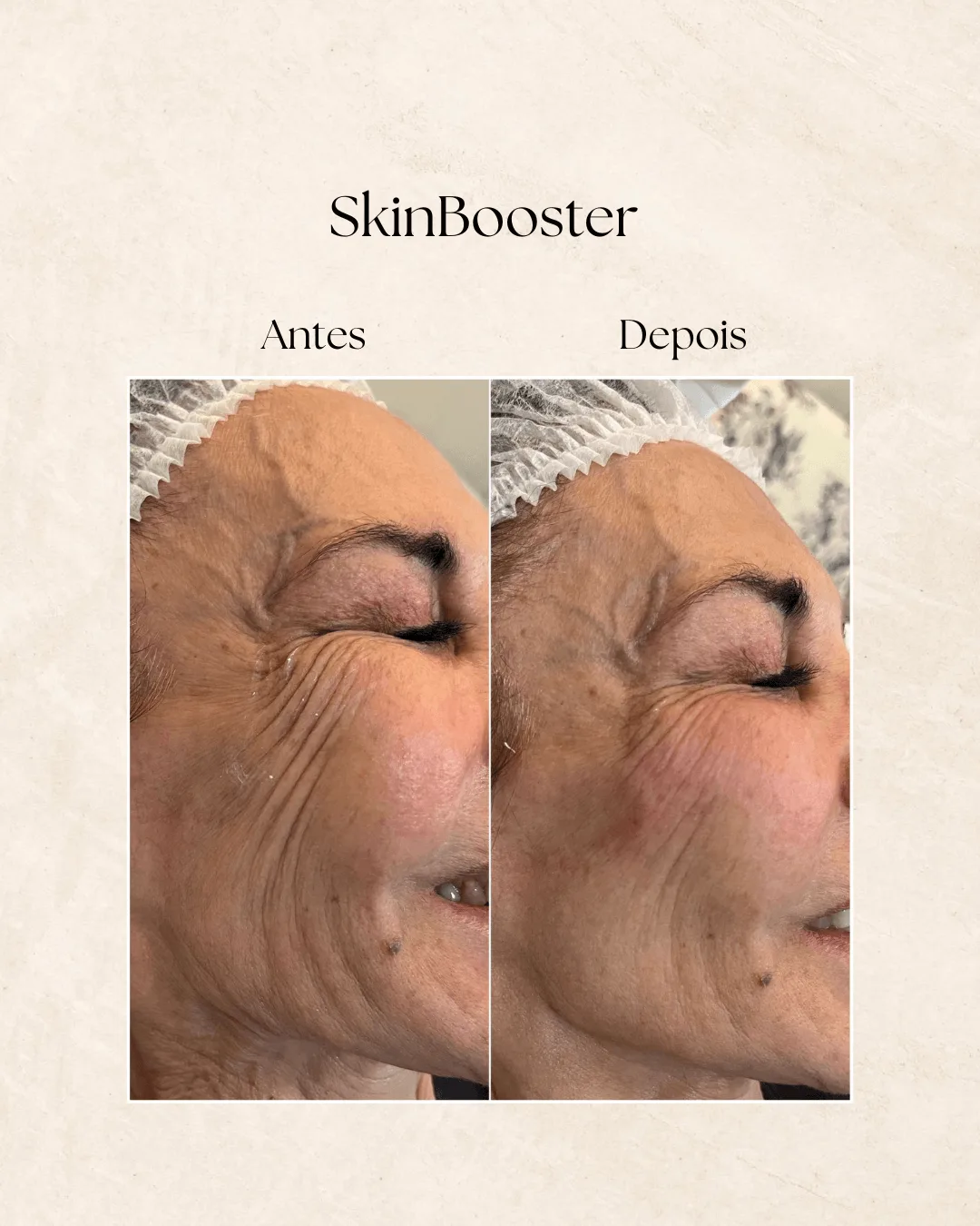 Procedimentos Injetáveis estéticos como skinbooster na Clínica Dermique