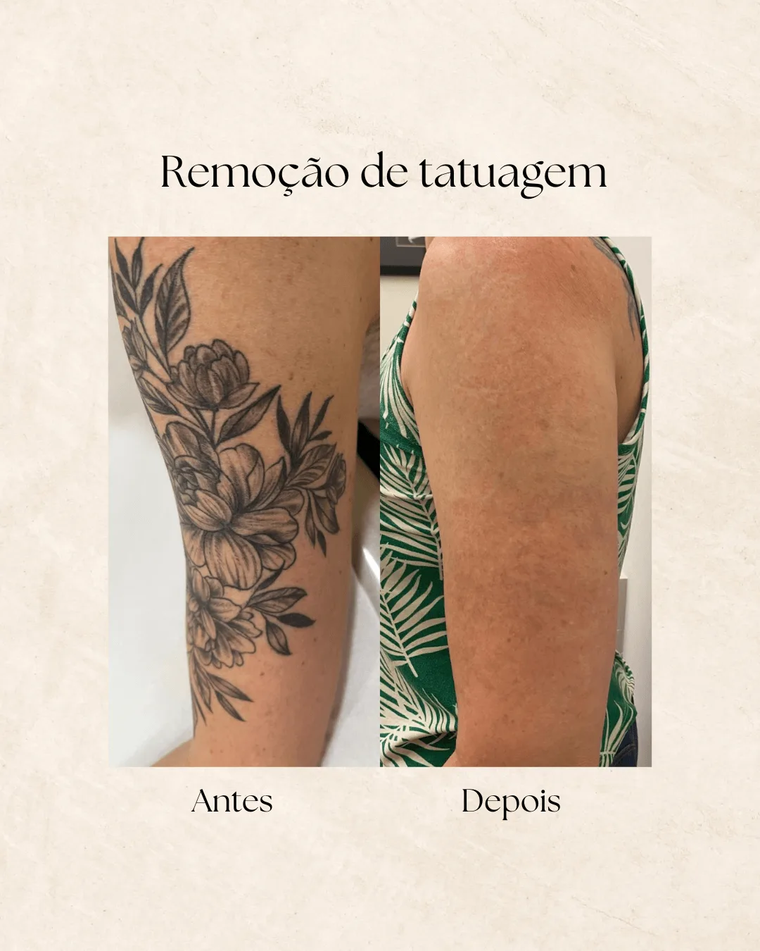 Remoção de tatuagem — antes e depois 1
