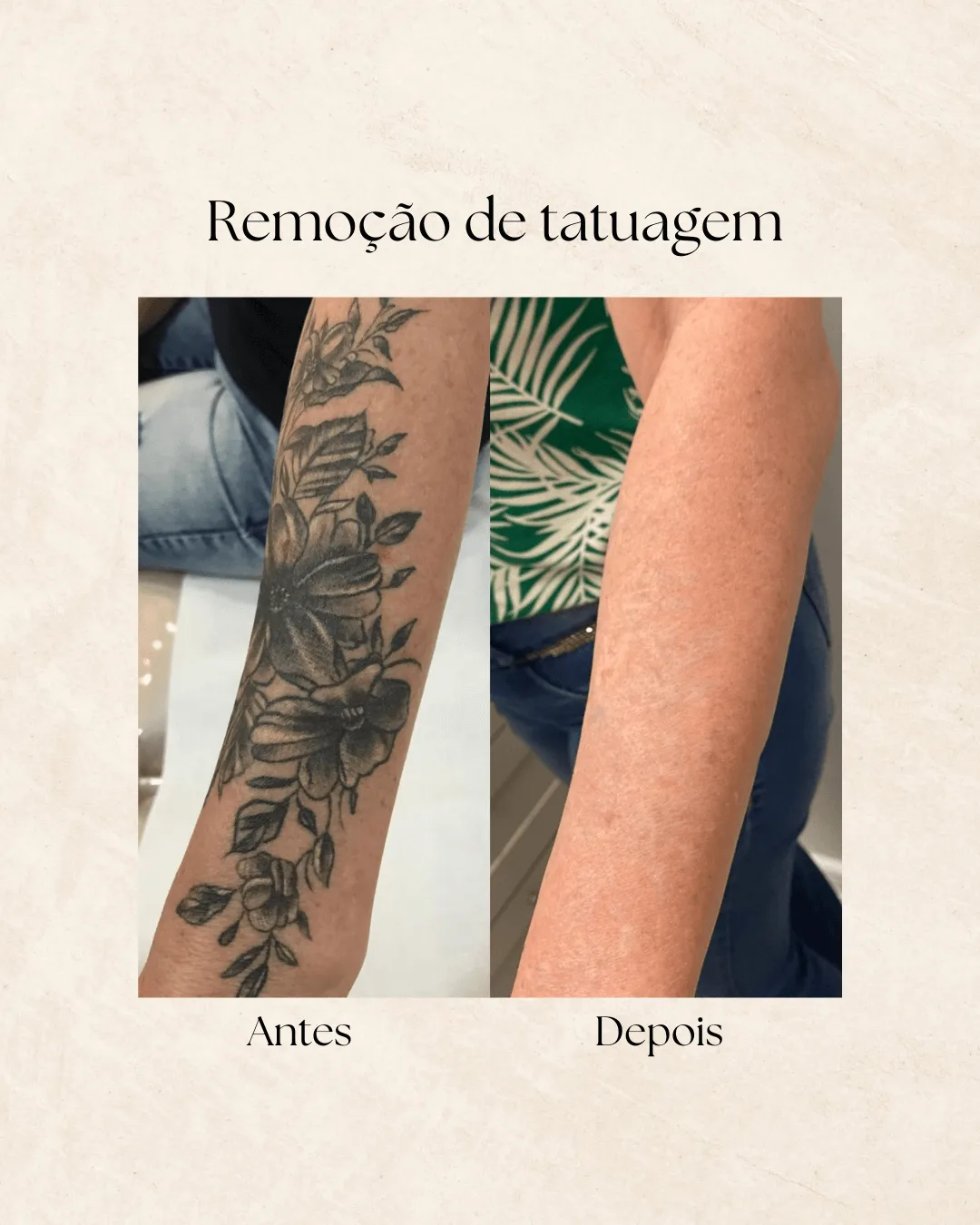 Remoção de tatuagem — antes e depois 2
