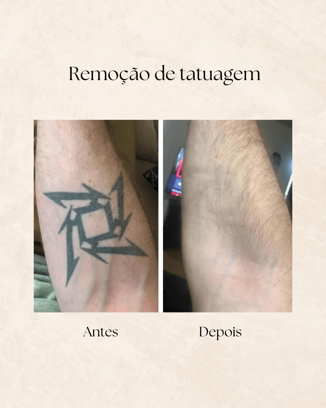 Remoção de tatuagem — antes e depois 3
